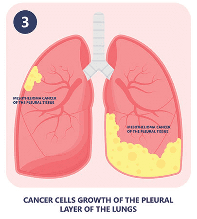 how mesothelioma happens part 3